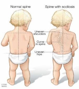 torticollis in baby